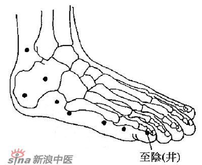 胎位不正 試試艾灸“至陰穴”